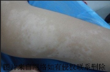 白癜风患者宜吃哪些蔬菜呢