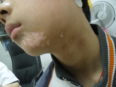 白癜风对患者的危害有哪些