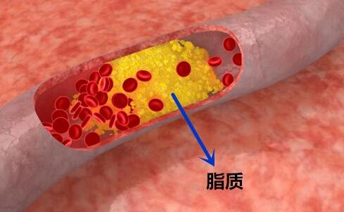 压力大的人更易患动脉硬化？科学睡眠与动脉硬化说拜拜